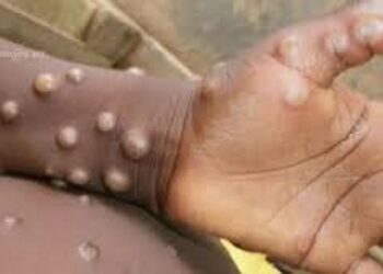 L&rsquo;OMS déclare que l&rsquo;épidémie de mpox en Afrique est une urgence sanitaire internationale