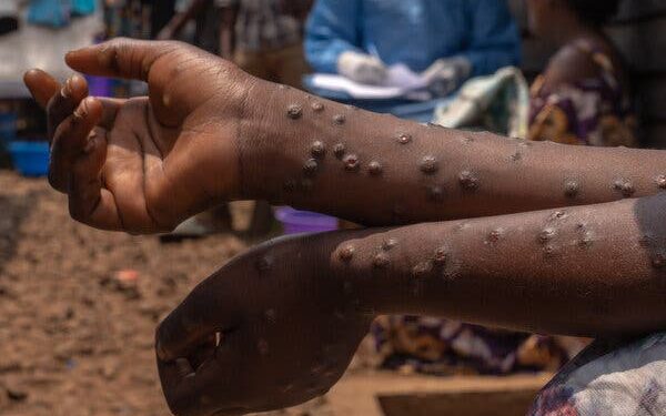 Urgent : la Guinée enregistre son premier cas de Mpox confirmé