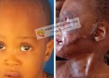 Le petit Maxime, victime de graves brûlures à Conakry : une voisine accusée, un appel à l’aide lancé !