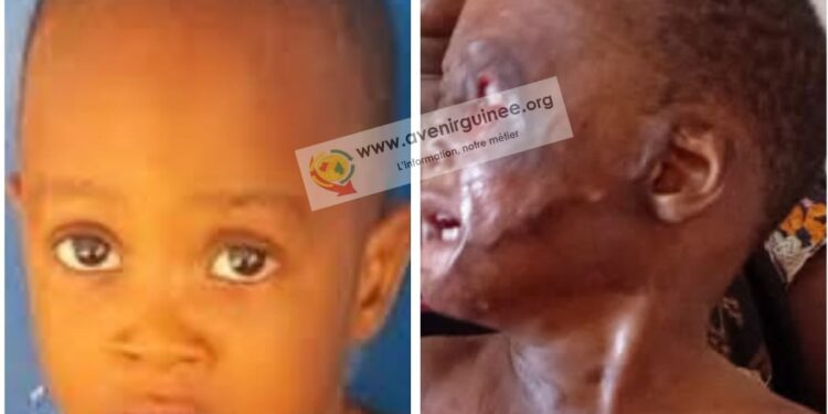 Le petit Maxime, victime de graves brûlures à Conakry : une voisine accusée, un appel à l’aide lancé !