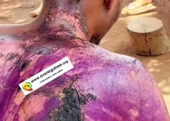 Drame conjugal à Madina : Un jeune commerçant brûlé à l&rsquo;eau bouillante par son épouse pendant son sommeil