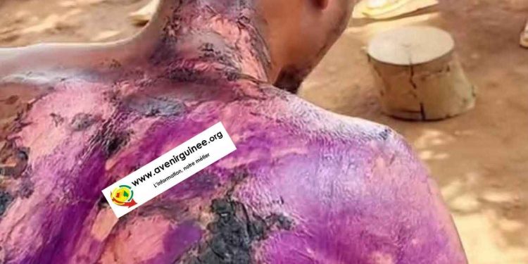 Drame conjugal à Madina : Un jeune commerçant brûlé à l&rsquo;eau bouillante par son épouse pendant son sommeil