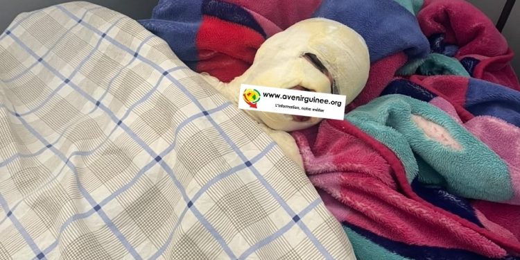 Labé : un apprenti de 14 ans frôle le pire après avoir été brûlé au feu